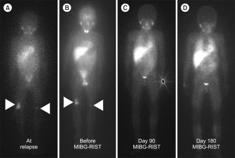 Allogeneic stem cell transplantation for neuroblastoma.