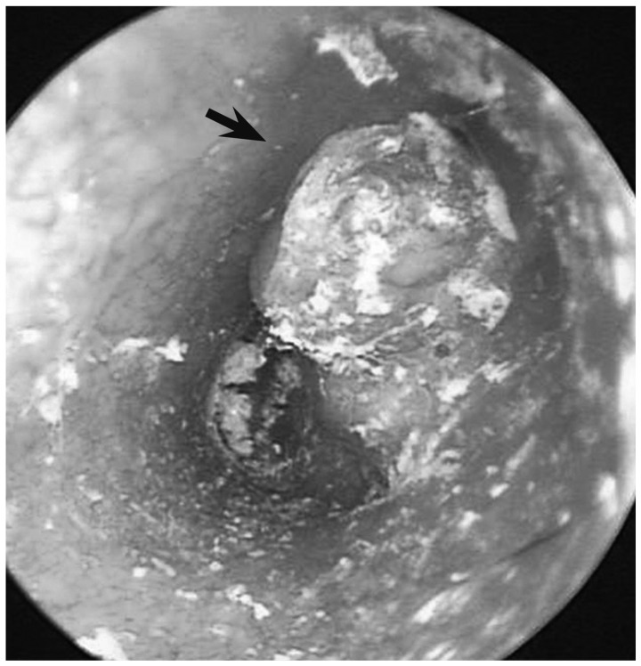 A case of middle ear adenoma.