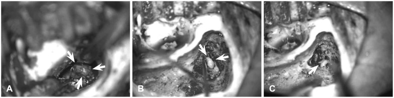 A case of middle ear adenoma.