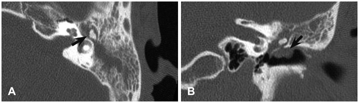 A case of middle ear adenoma.