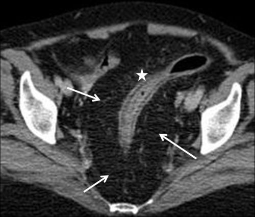 Pelvic lipomatosis: US and CT diagnosis.