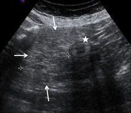 Pelvic lipomatosis: US and CT diagnosis.