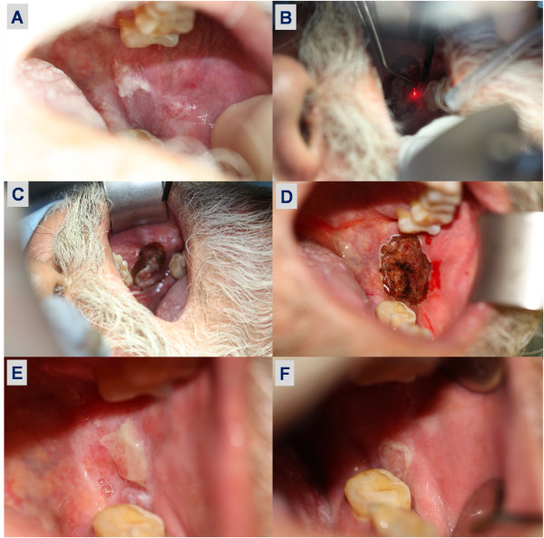 CO2 lasers in the management of potentially malignant and malignant oral disorders.