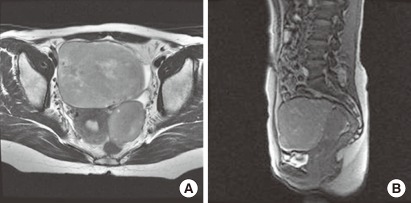 A case of primary ovarian lymphoma presenting as a rectal submucosal tumor.