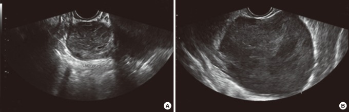 A case of primary ovarian lymphoma presenting as a rectal submucosal tumor.