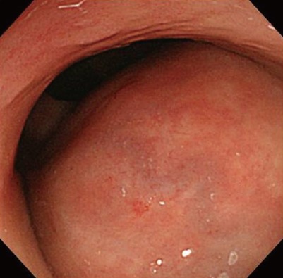 A case of primary ovarian lymphoma presenting as a rectal submucosal tumor.