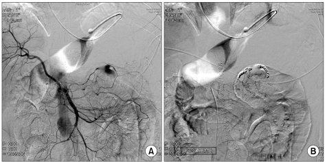 Spontaneous aortic rupture in a patient with neurofibromatosis type 1.