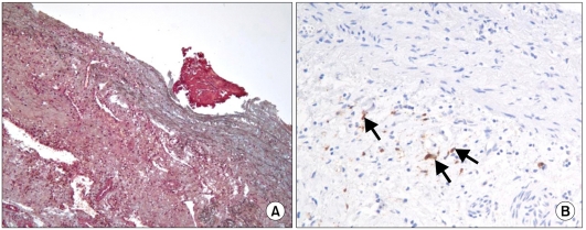 Spontaneous aortic rupture in a patient with neurofibromatosis type 1.