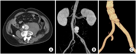 Spontaneous aortic rupture in a patient with neurofibromatosis type 1.