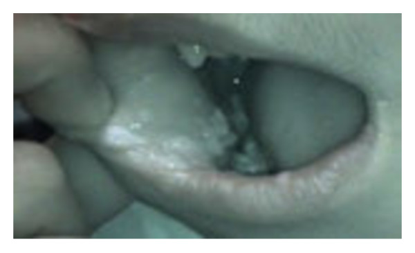 Oral HPV infection and MHC class II deficiency (A study of two cases with atypical outcome).