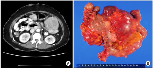 Oncologic manifestations of neurofibromatosis type 1 in Korea.