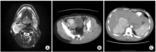 Oncologic manifestations of neurofibromatosis type 1 in Korea.