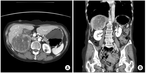 Oncologic manifestations of neurofibromatosis type 1 in Korea.