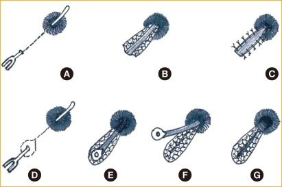 Comparison of a fistulectomy and a fistulotomy with marsupialization in the management of a simple anal fistula: a randomized, controlled pilot trial.