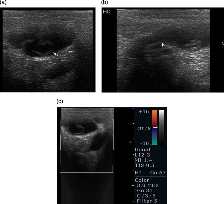 Hydrocele of the canal of Nuck: imaging findings.