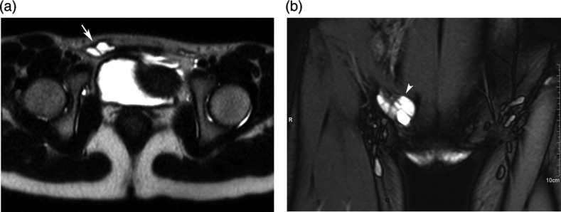 Hydrocele of the canal of Nuck: imaging findings.