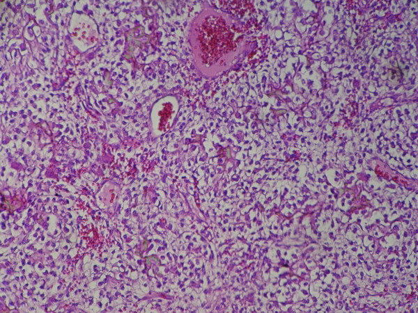 Clear cell chondrosarcoma of the head and neck.