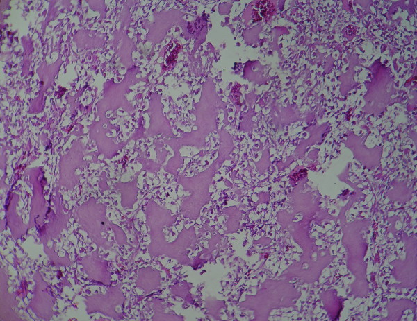 Clear cell chondrosarcoma of the head and neck.