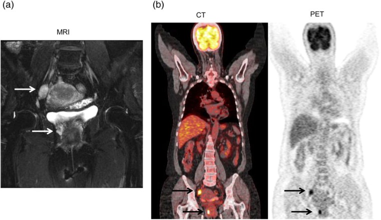 Uterine cervical melanoma presenting with rapid progression detected by PET/CT.