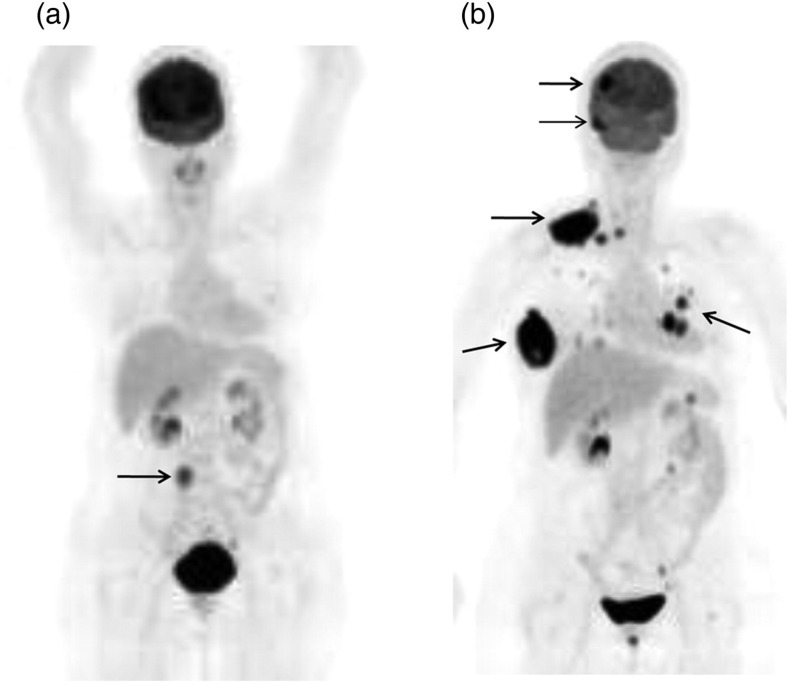 Uterine cervical melanoma presenting with rapid progression detected by PET/CT.