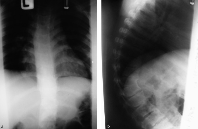 Thoracic pedicle subtraction osteotomy in a pediatric patient: a case report.