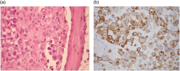 Uterine cervical melanoma presenting with rapid progression detected by PET/CT.