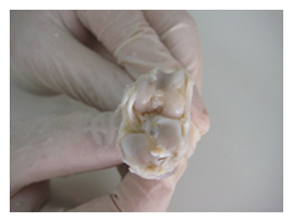 An assessment of the chondroprotective effects of intra-articular application of statin and tetracycline on early-stage experimental osteoarthritis.