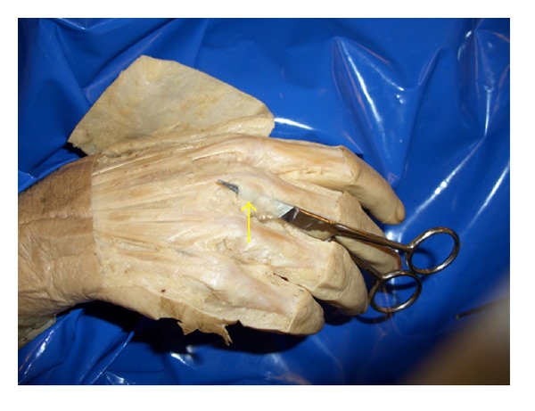 Role of the juncturae tendinum in preventing radial subluxation of the extensor communis tendons after ulnar sagittal band rupture: a cadaveric study.