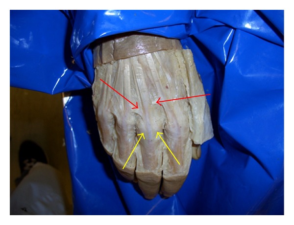 Role of the juncturae tendinum in preventing radial subluxation of the extensor communis tendons after ulnar sagittal band rupture: a cadaveric study.