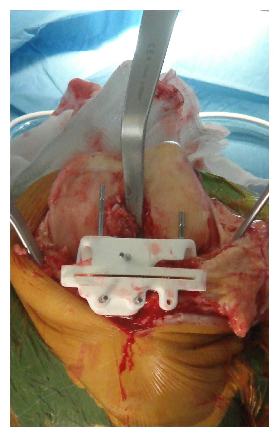 Assessing the accuracy of bone resection by cutting blocks in patient-specific total knee replacements.