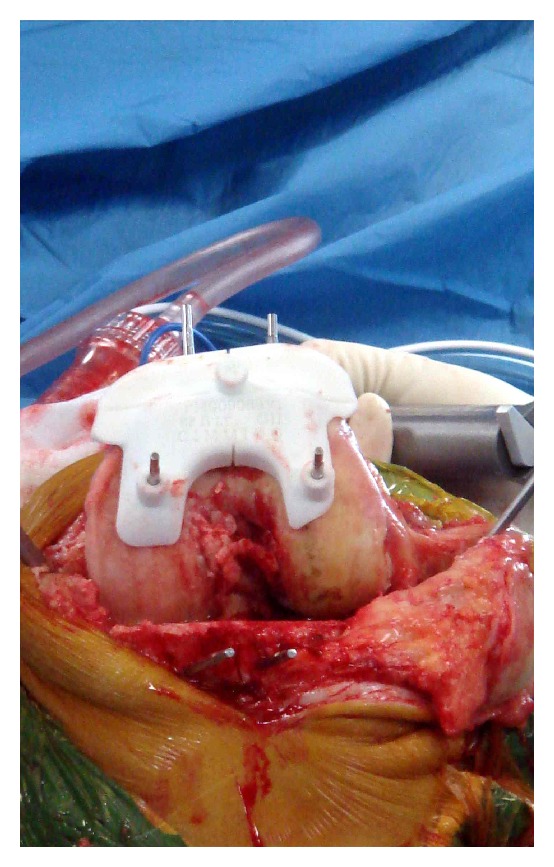 Assessing the accuracy of bone resection by cutting blocks in patient-specific total knee replacements.