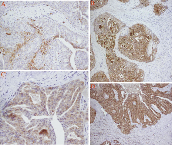 Expression of Glut-1, HIF-1α, PI3K and p-Akt in a case of ceruminous adenoma.