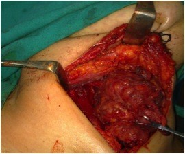 Metastatic rhabdomyosarcoma of the thyroid gland, a case report.