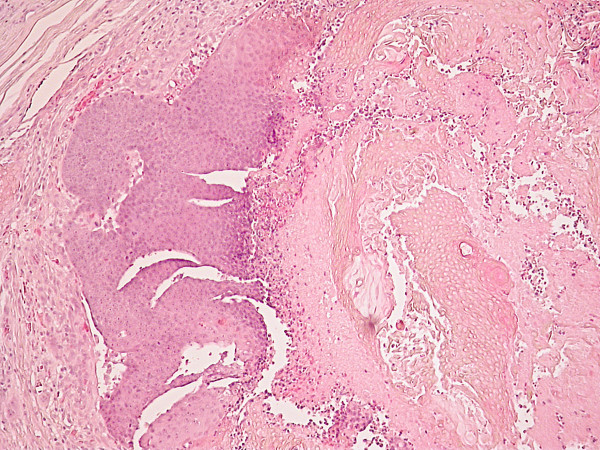 A patient with ulcerated calcifying epithelioma of Malherbe in the pinna: case report.