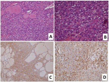 Metastatic rhabdomyosarcoma of the thyroid gland, a case report.