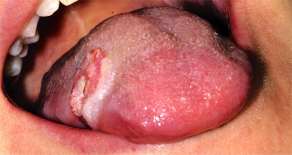 Tongue cancer in young patients: case report of a 26-year-old patient.