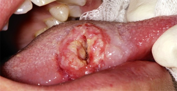 Tongue cancer in young patients: case report of a 26-year-old patient.