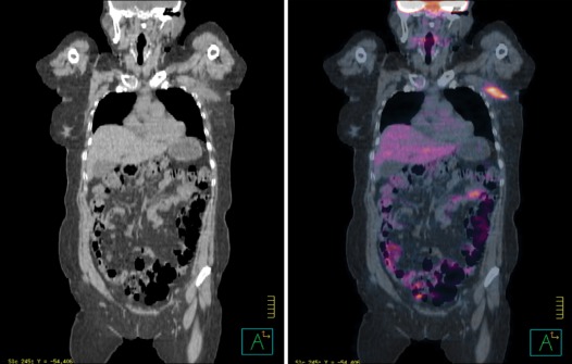 Interdigitating dendritic cell sarcoma occured alone in axilla.