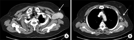 Interdigitating dendritic cell sarcoma occured alone in axilla.