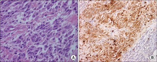 Interdigitating dendritic cell sarcoma occured alone in axilla.