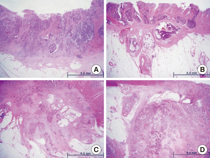 Does t3 subdivision correlate with nodal or distant metastasis in colorectal cancer?