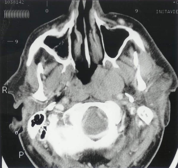 A patient with primary Burkitt's lymphoma of the postnasal space: case report.