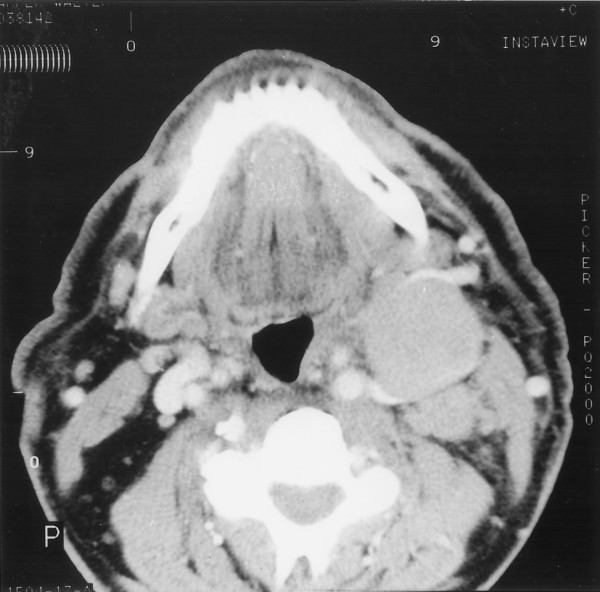 A patient with primary Burkitt's lymphoma of the postnasal space: case report.