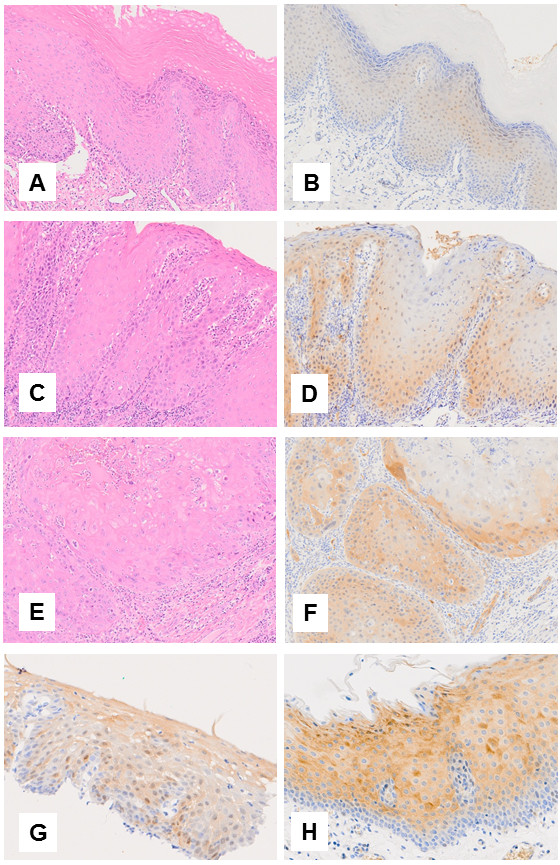 p16 overexpression in malignant and premalignant lesions of the oral and esophageal mucosa following allogeneic hematopoietic stem cell transplantation.