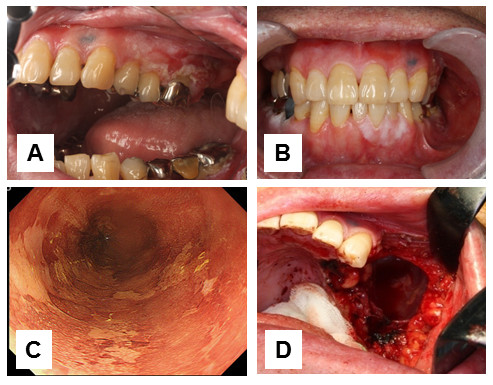 p16 overexpression in malignant and premalignant lesions of the oral and esophageal mucosa following allogeneic hematopoietic stem cell transplantation.