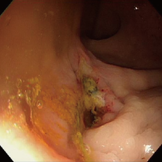 Treatment of a recurrent rectourethral fistula by using transanal rectal flap advancement and fibrin glue: a case report.