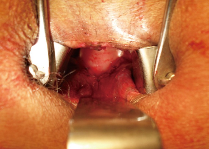 Treatment of a recurrent rectourethral fistula by using transanal rectal flap advancement and fibrin glue: a case report.