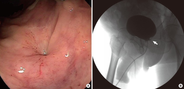 Treatment of a recurrent rectourethral fistula by using transanal rectal flap advancement and fibrin glue: a case report.