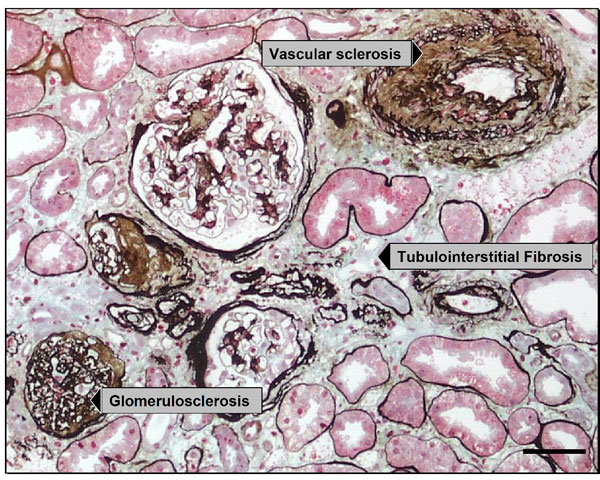 Fibrosis in the kidney: is a problem shared a problem halved?