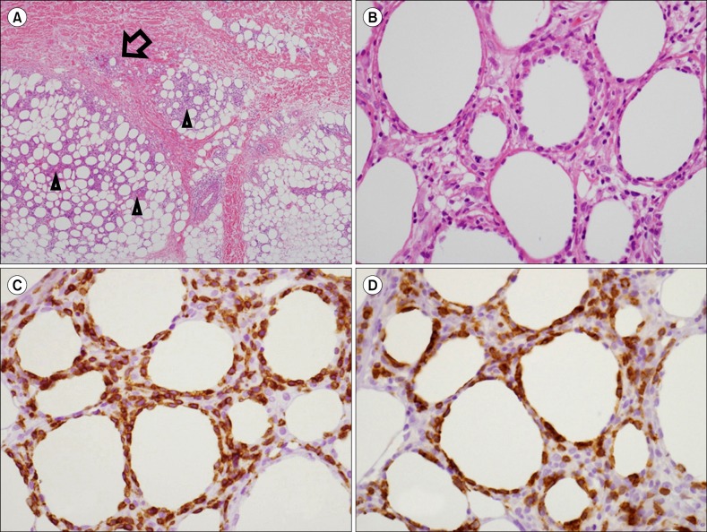 Cyclosporine A treatment for relapsed subcutaneous panniculitis-like T-cell lymphoma: a case with long-term follow-up.